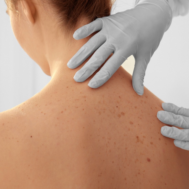 Melanoma Prevention and Awareness