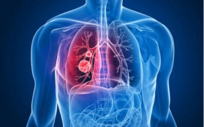 Game Changing Neoadjuvant Lung Trial Enrolls the Most People in the World